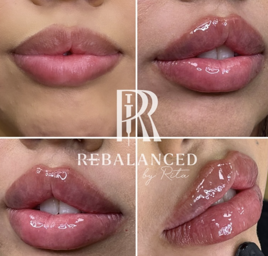 best lip filler injector in Buckeye, Arizona