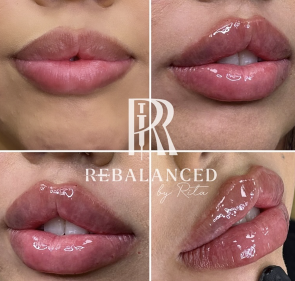best lip filler injector in Buckeye, Arizona