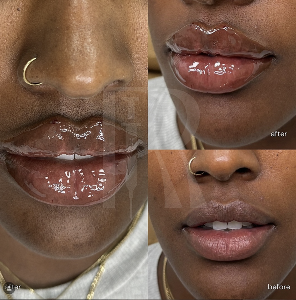 Lip Fillers in Scottsdale and Phoenix