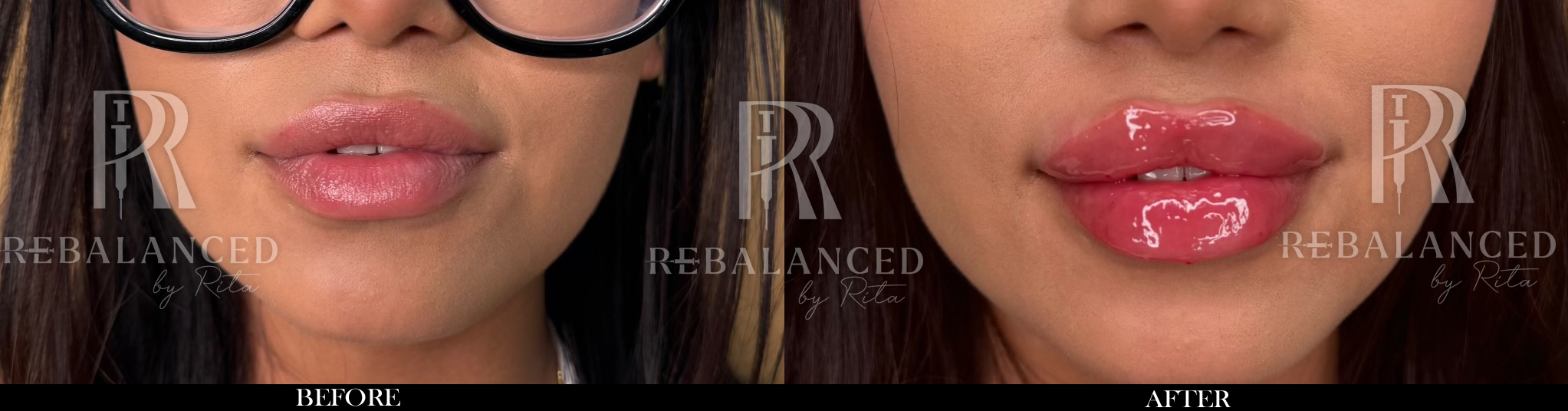 Russian lip technique before and after, Scottsdale lip filler